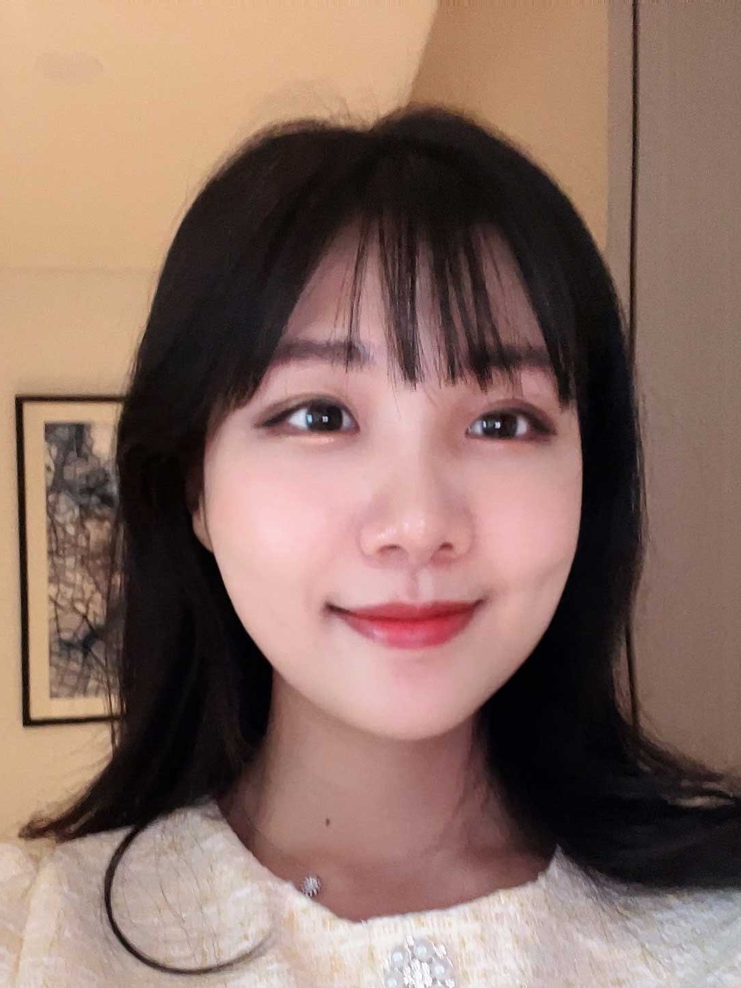 After Facial Contouring Case 2