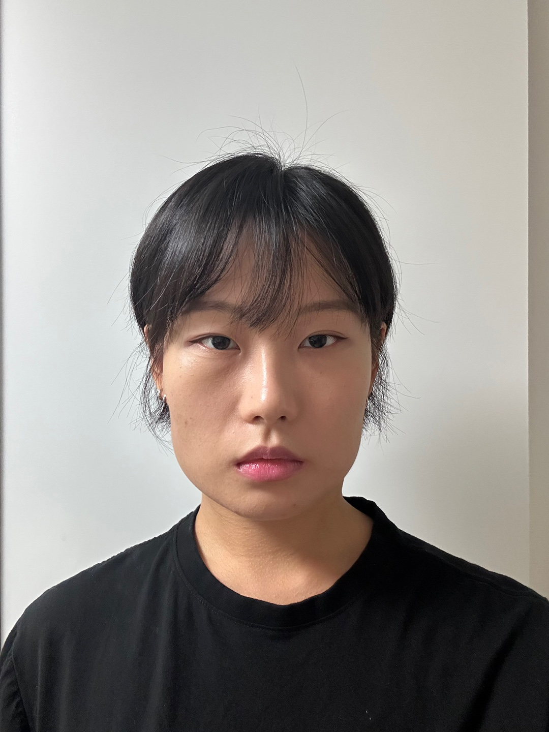 Before Facial Contouring Case 1